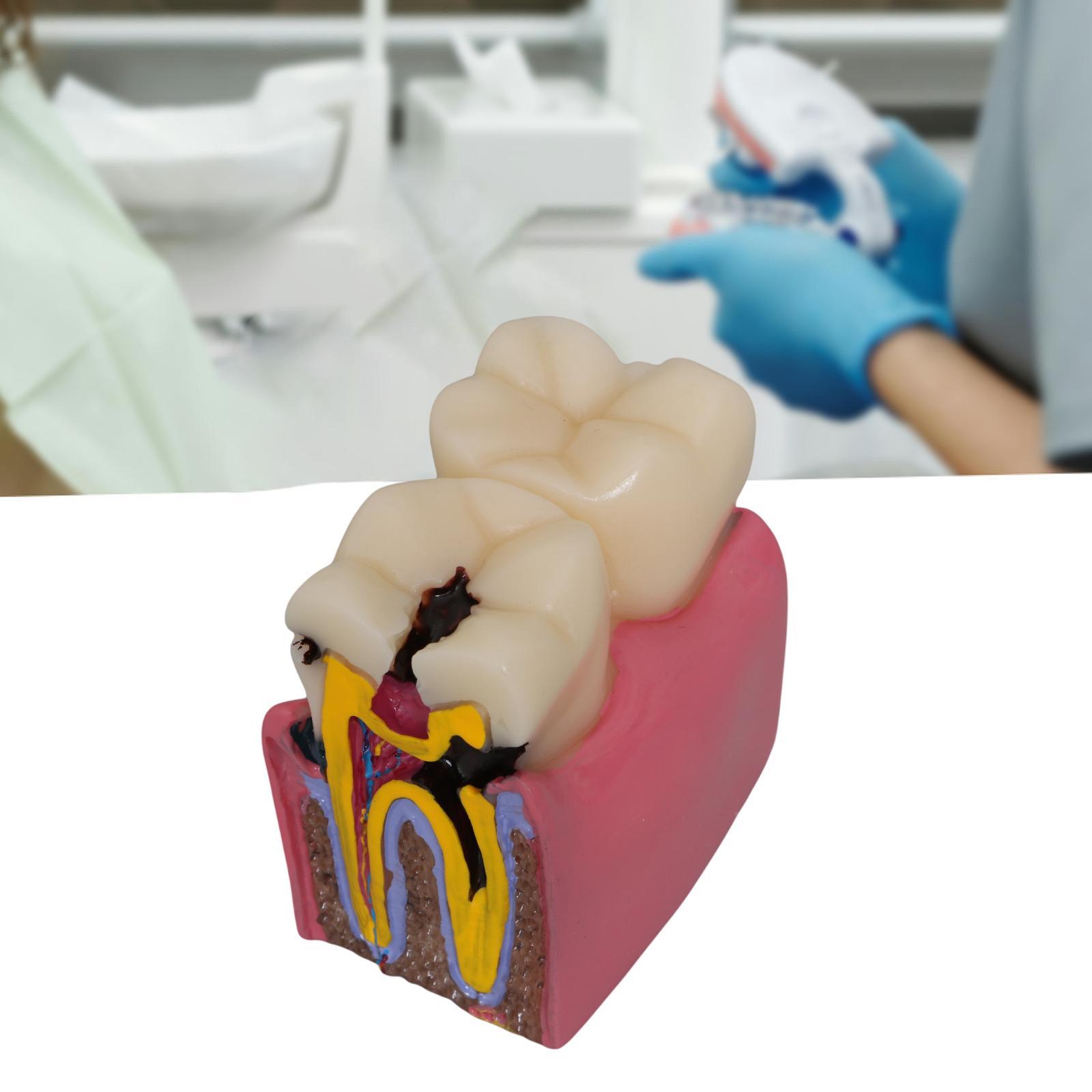Tooth Decay Model Roots Canal  - Kids Education Classes 评论和价格