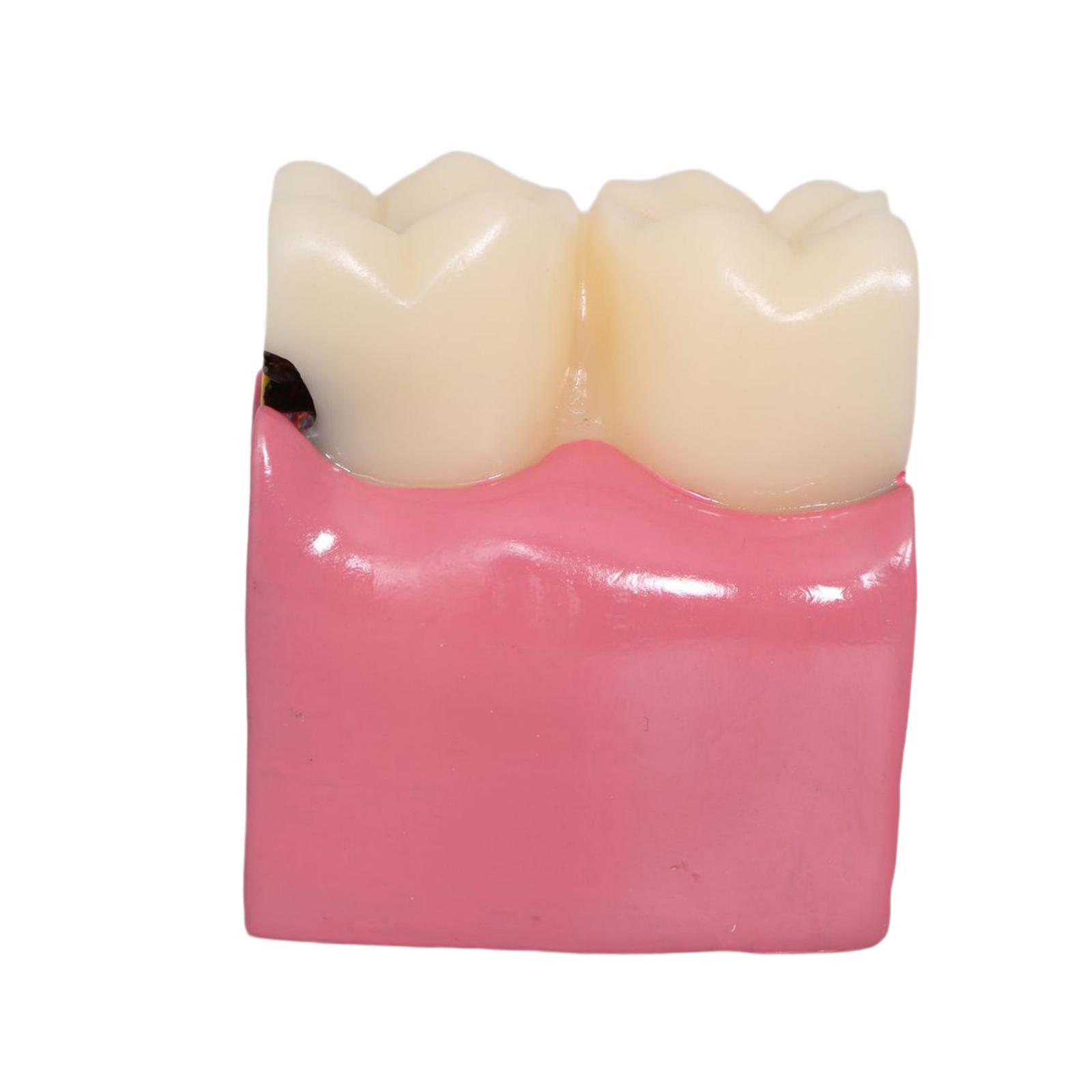 Tooth Decay Model Roots Canal  - Kids Education Classes 评论和价格