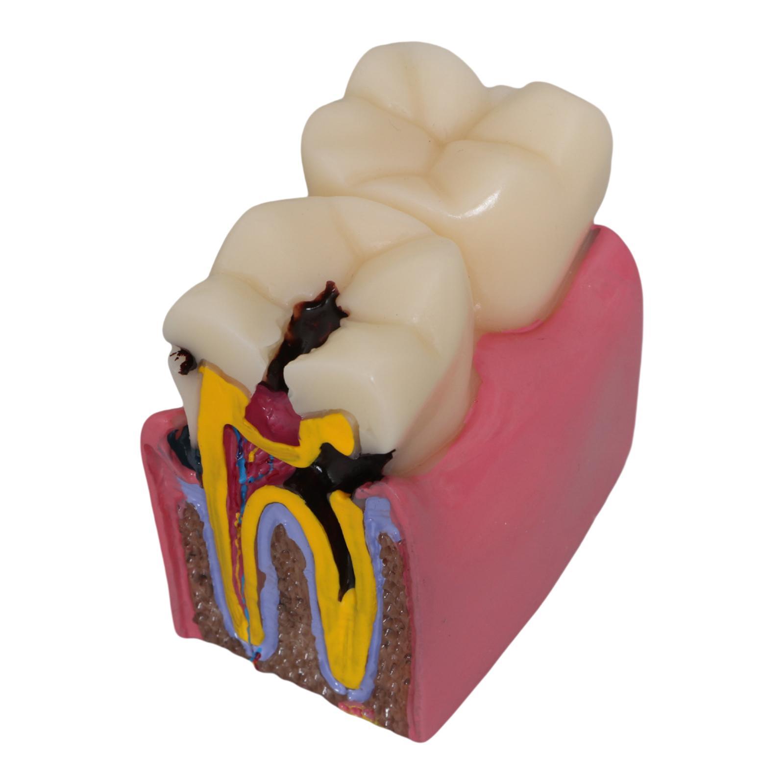 Tooth Decay Model Roots Canal  - Kids Education Classes 评论和价格